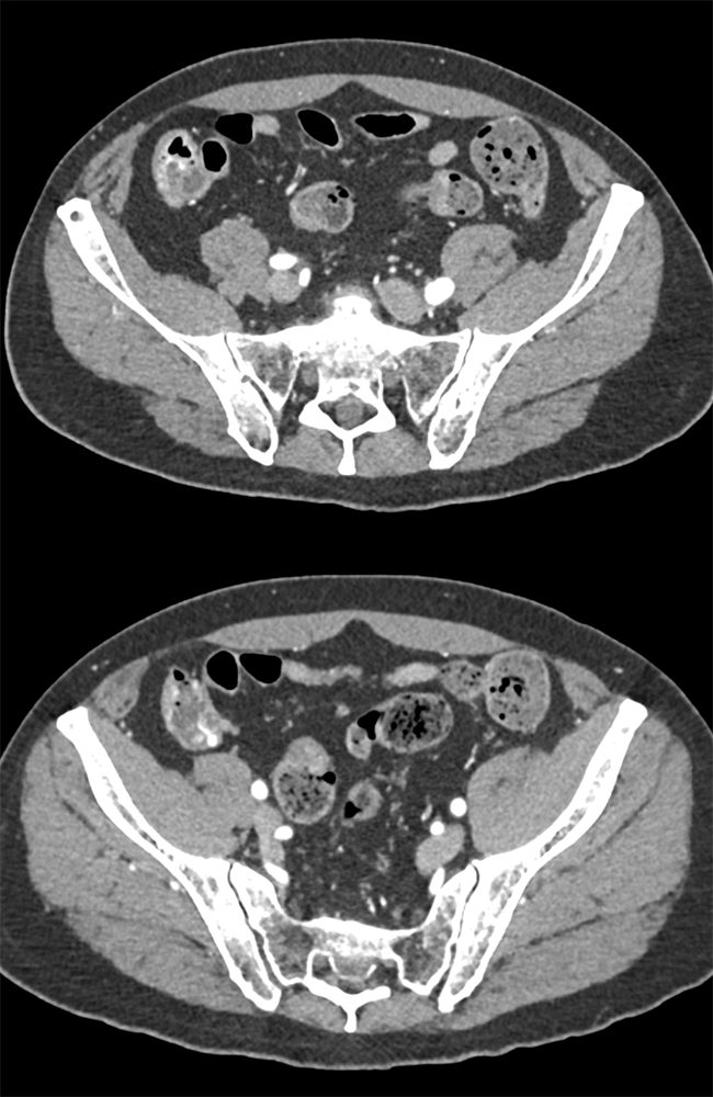 Ingested Material in Cecum Simulates a Bleed