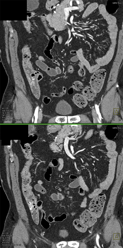 CT of GI Bleed