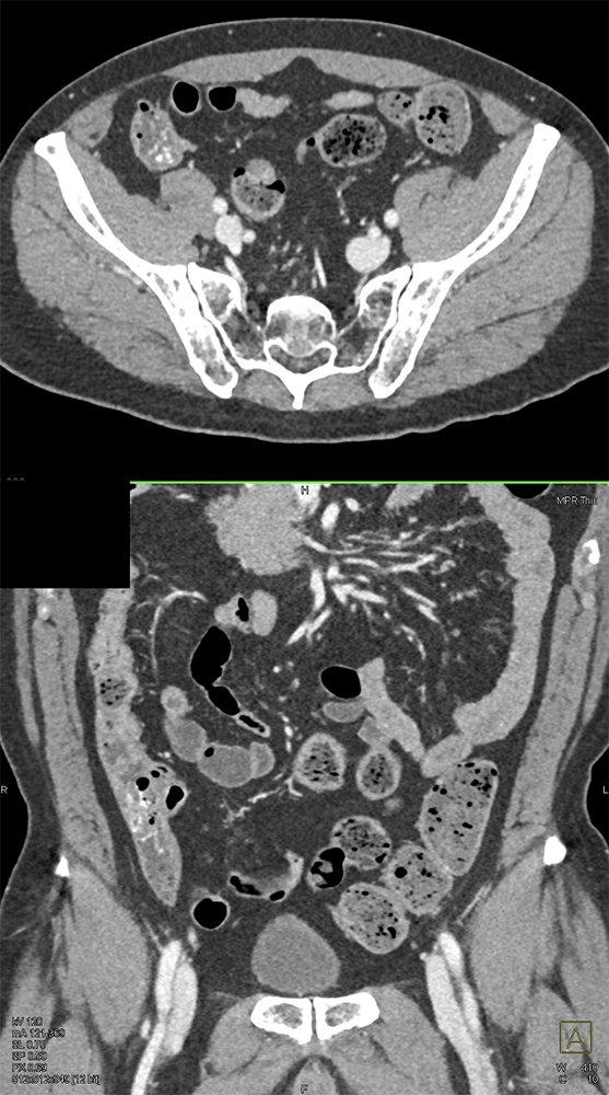 CT of GI Bleed