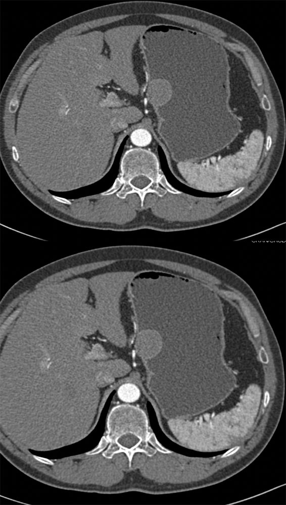 2 cm Gastric GIST Tumor