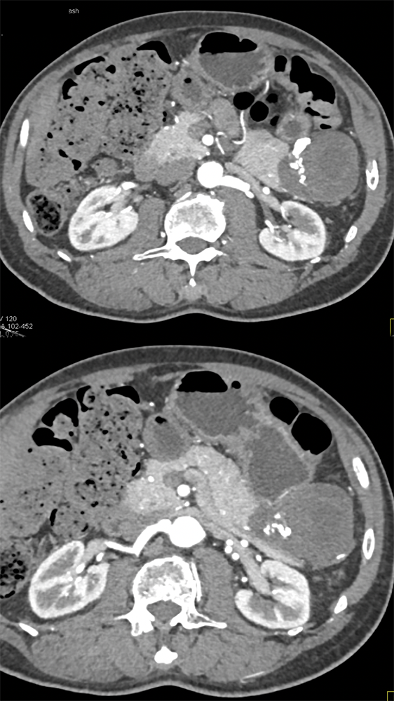 Gastric GIST Tumor