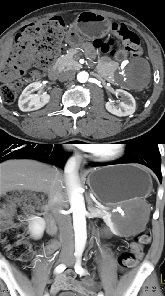 Gastric GIST Tumors