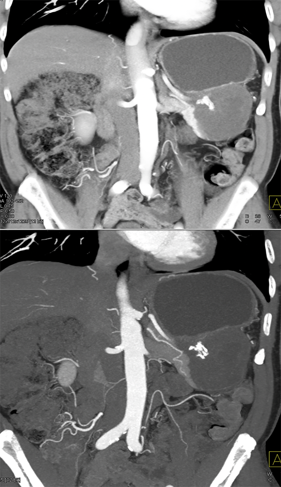 Gastric GIST Tumors