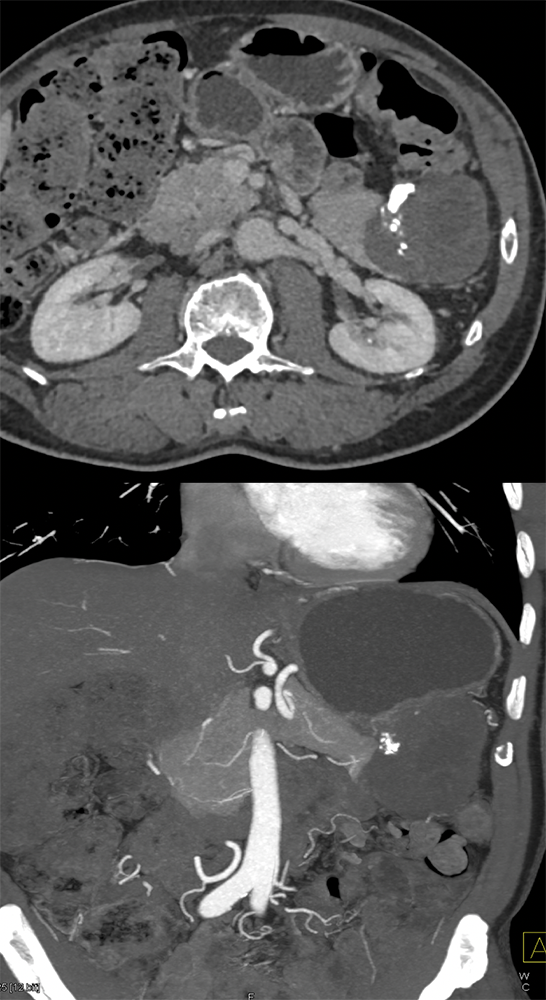 Gastric GIST Tumors