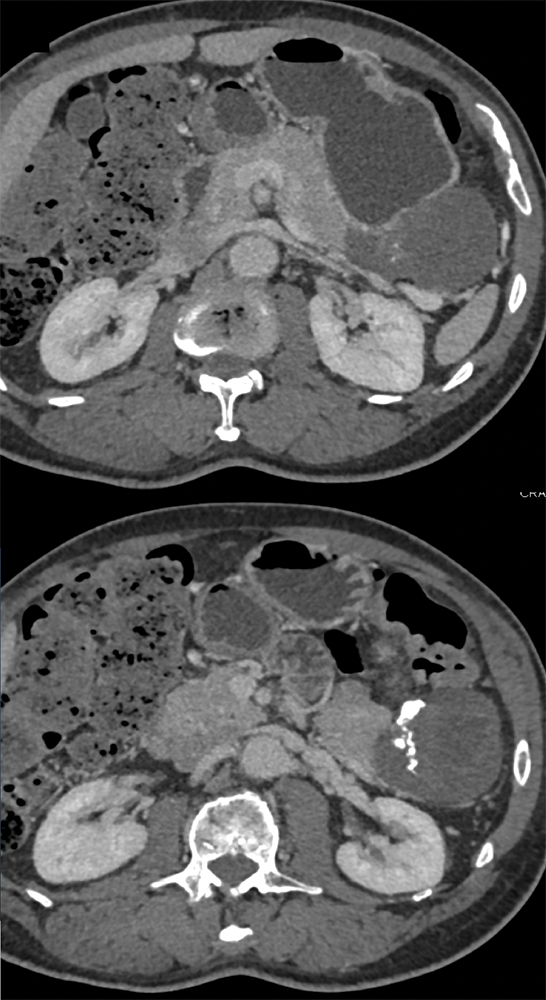 Gastric GIST Tumors