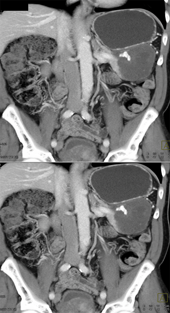 Gastric GIST Tumors