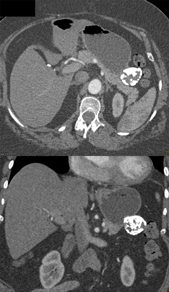 Gastric GIST Tumor