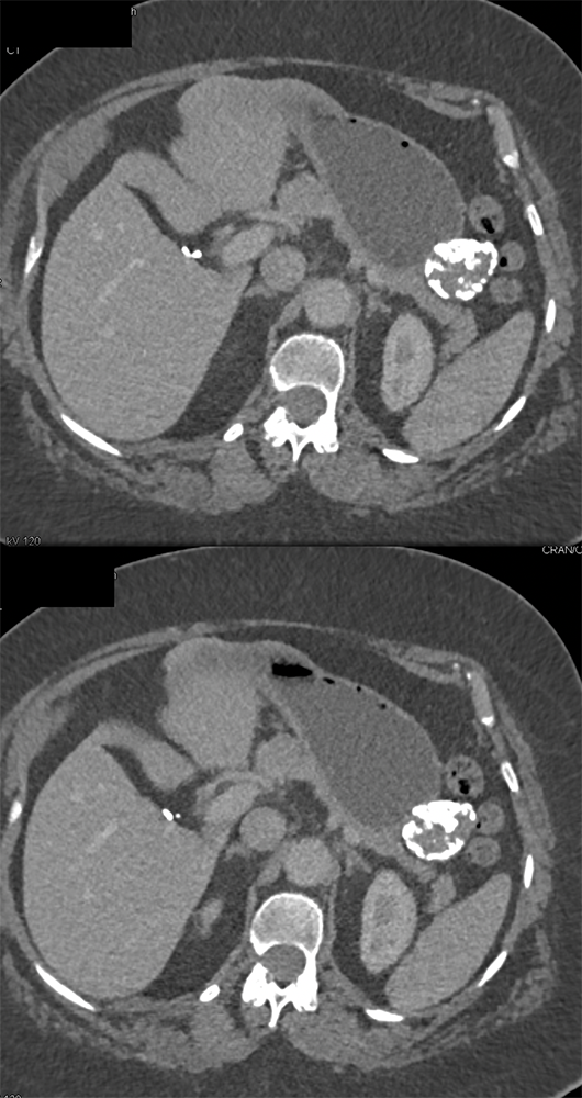 Gastric GIST Tumors