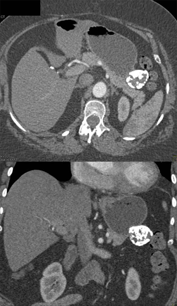 Gastric GIST Tumors