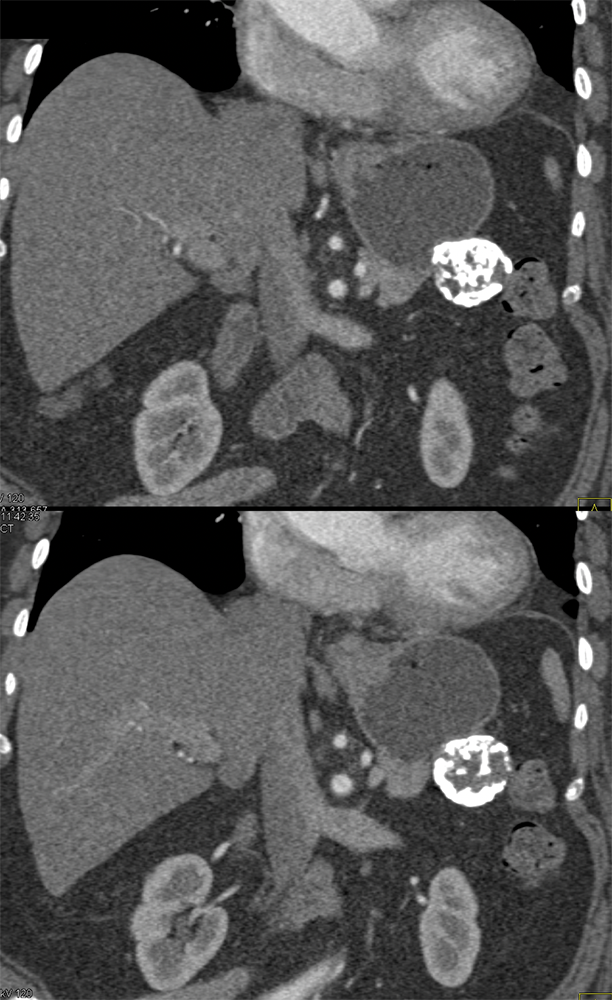 Gastric GIST Tumors