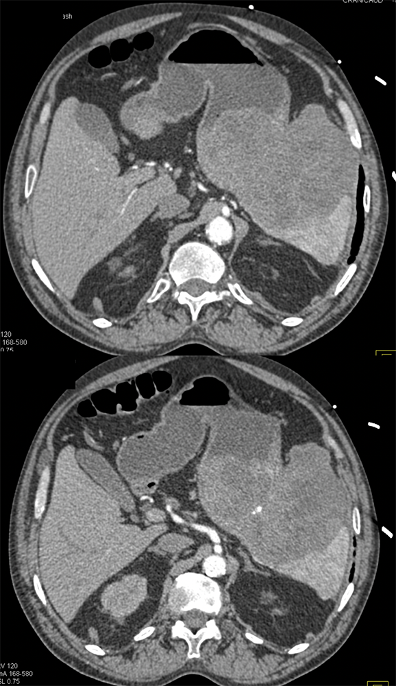 Gastric GIST Tumor