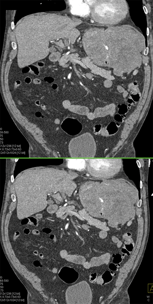 Gastric GIST Tumors