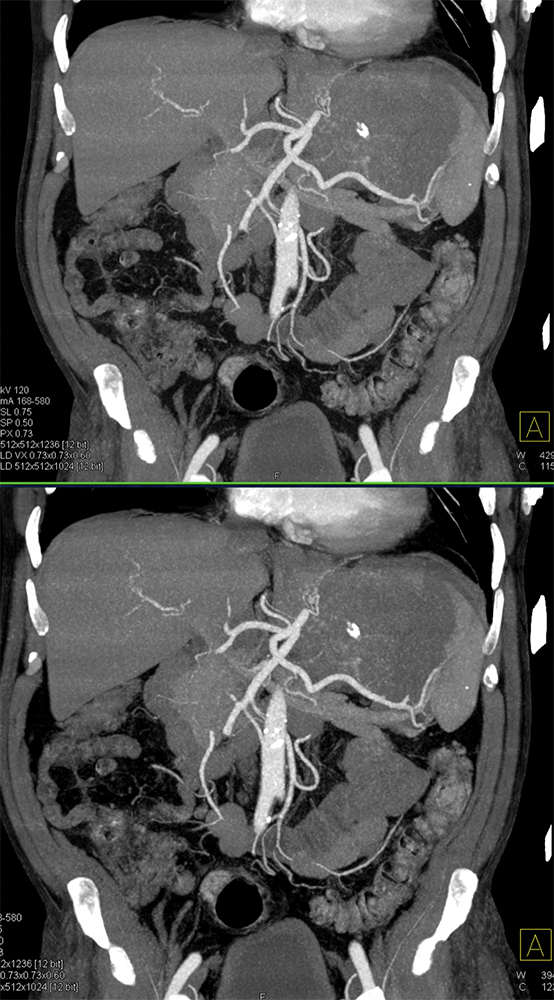 Gastric GIST Tumors