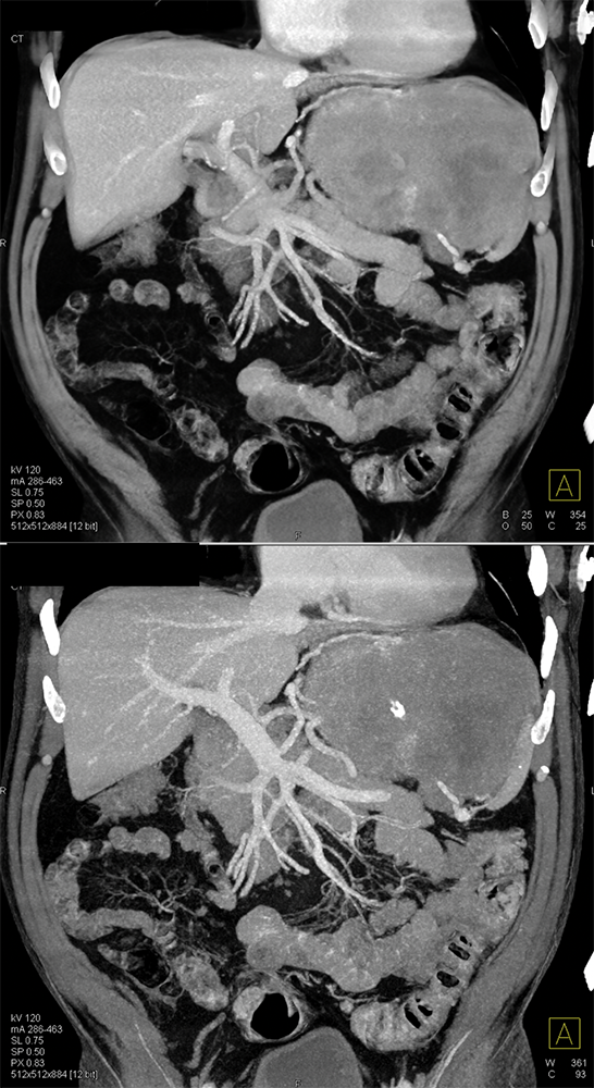 Gastric GIST Tumors