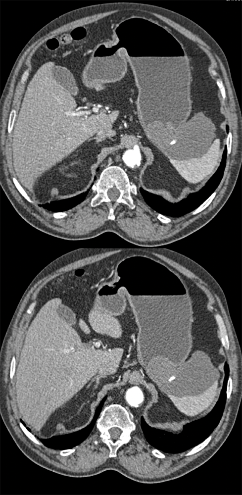 Gastric GIST Tumor with Faint Calcification