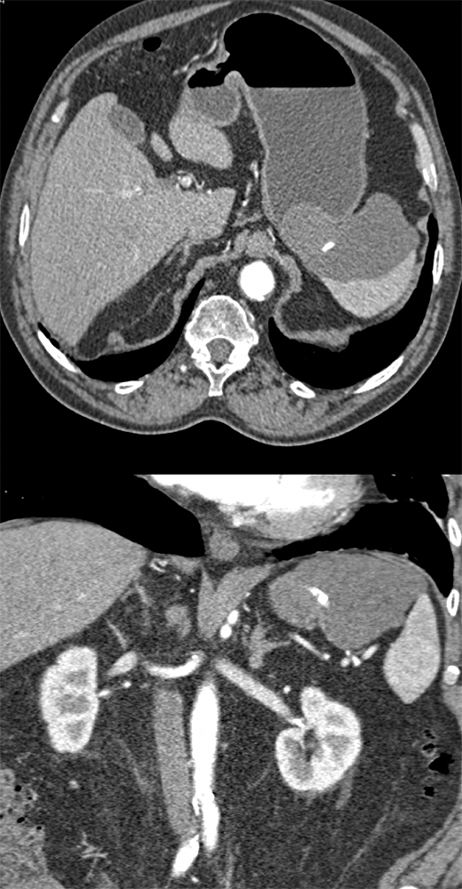 Gastric GIST Tumors