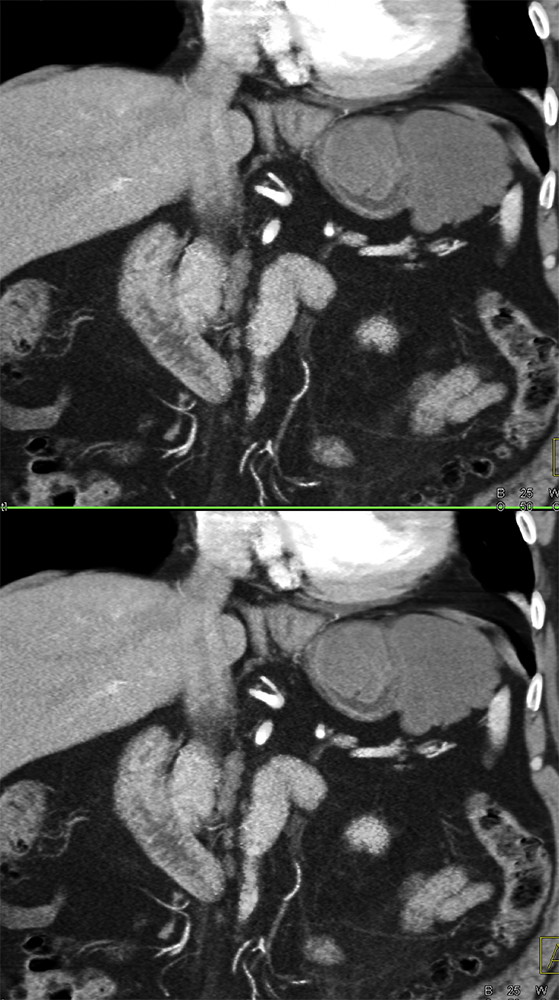 Gastric GIST Tumors