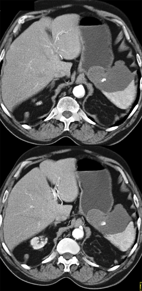 Gastric GIST Tumors