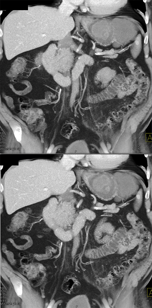 Gastric GIST Tumors