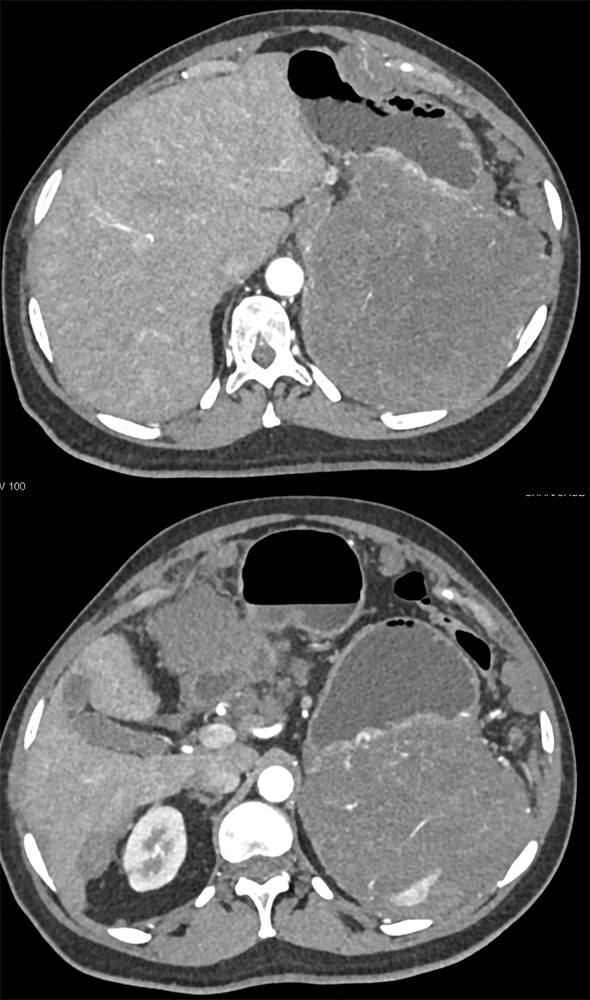 Gastric GIST Tumor with Spread