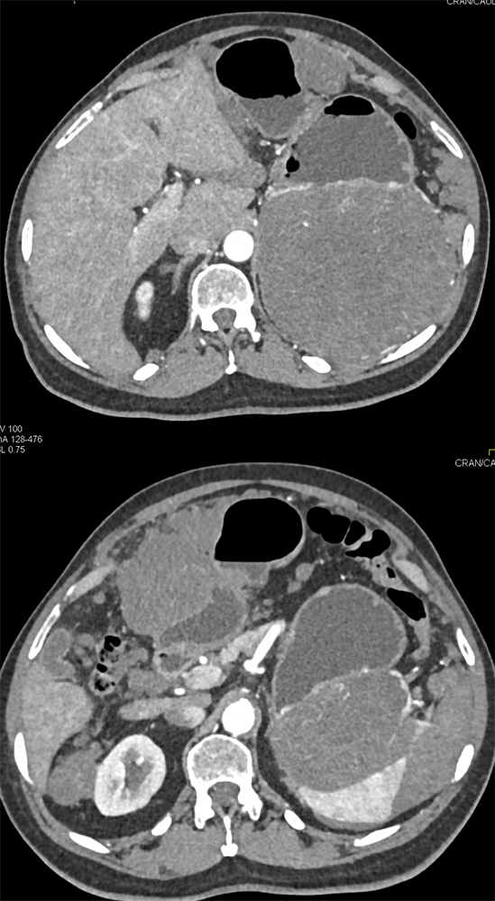 Gastric GIST Tumors