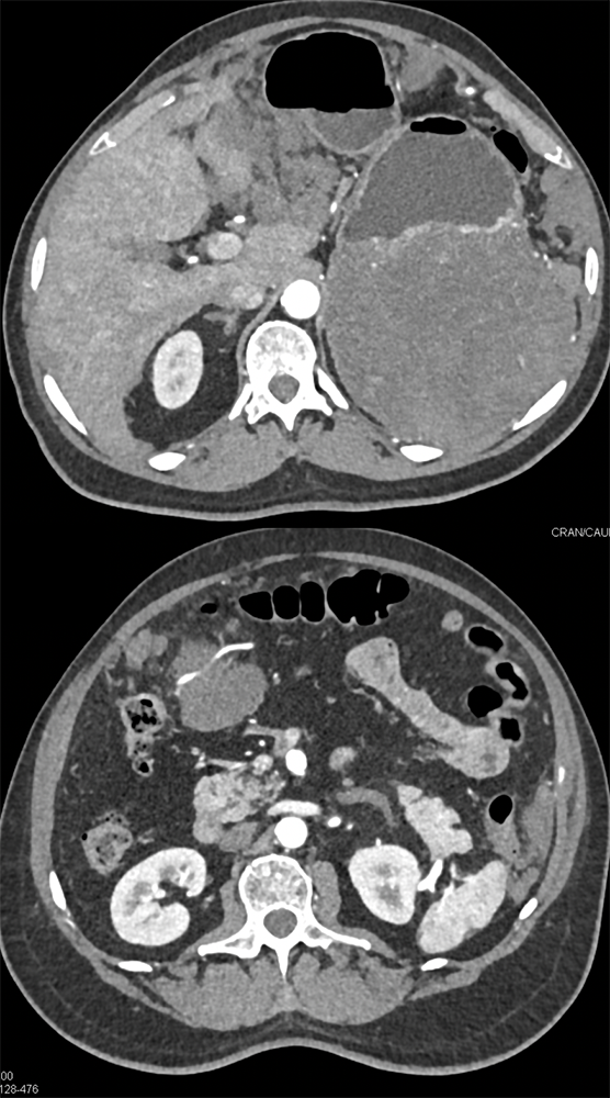 Gastric GIST Tumors