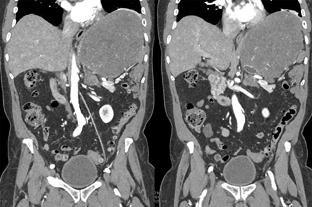 Gastric GIST Tumors