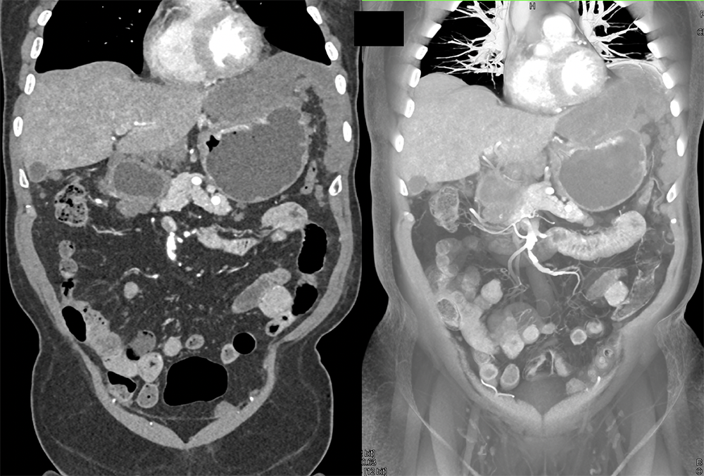 Gastric GIST Tumors