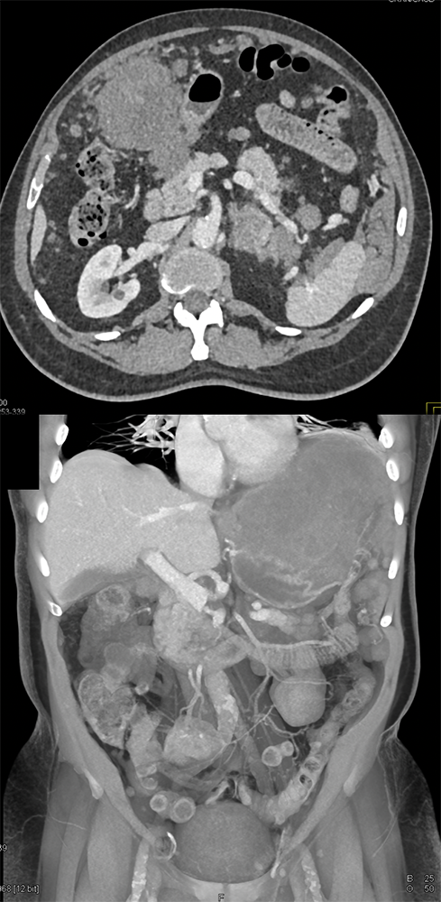 Gastric GIST Tumors