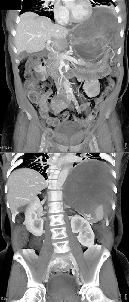 Gastric GIST Tumors