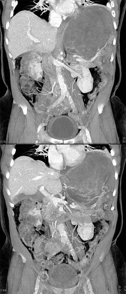 Gastric GIST Tumors