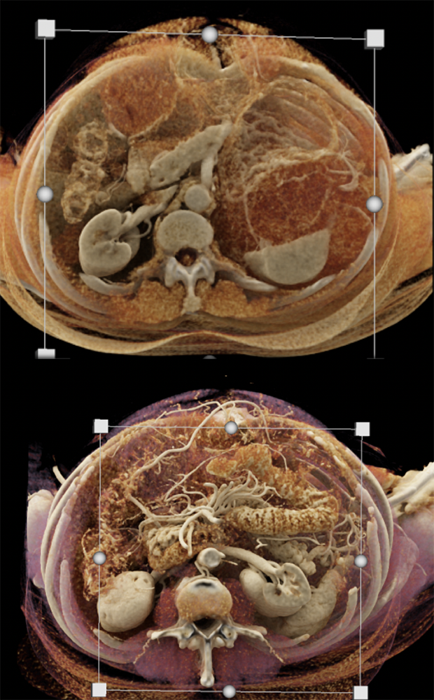 Gastric GIST Tumor with Spread