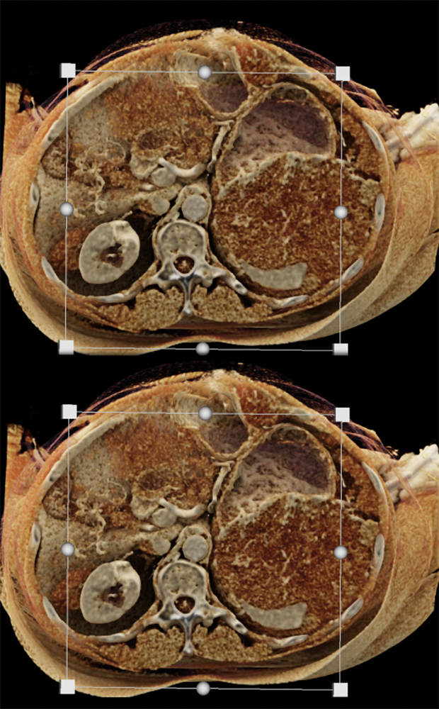 Gastric GIST Tumor with Spread