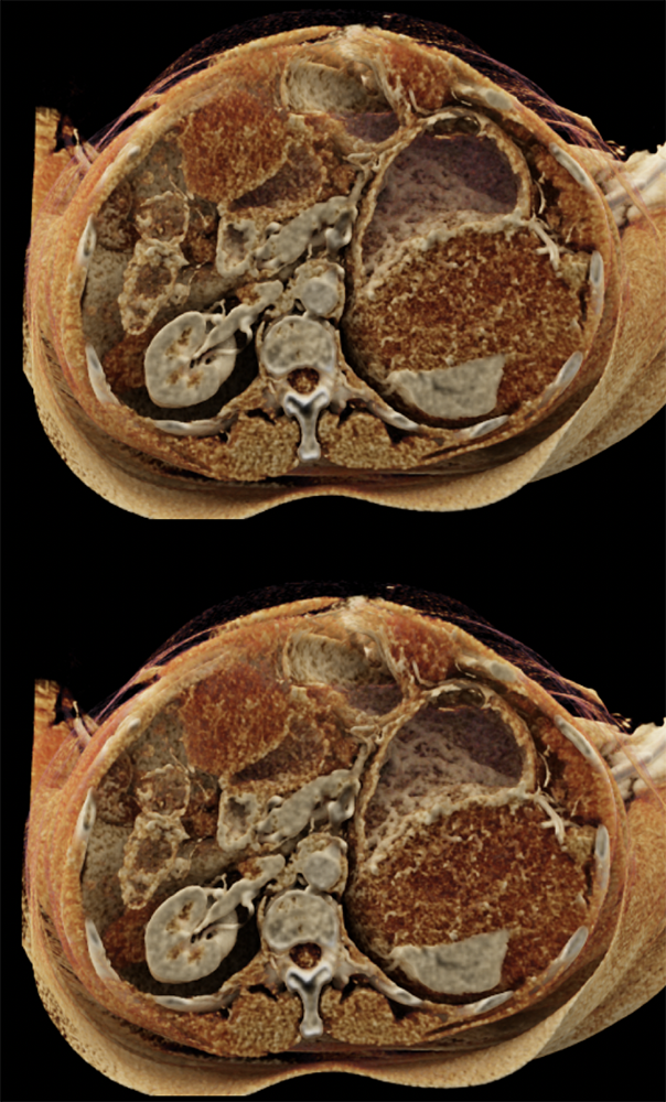 Gastric GIST Tumors