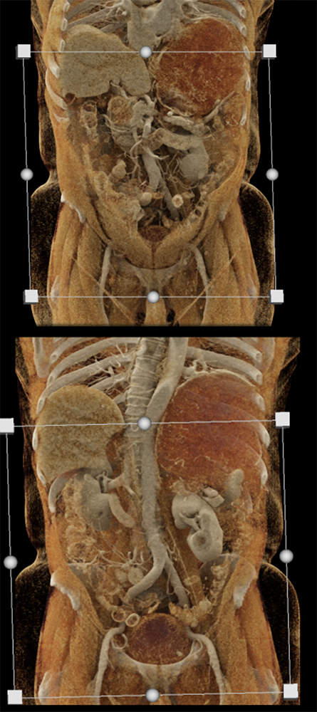 Gastric GIST Tumors