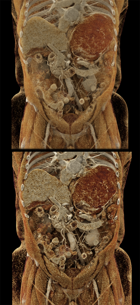 Gastric GIST Tumors