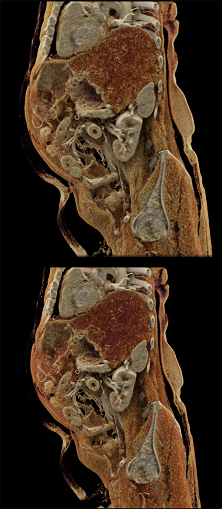 Gastric GIST Tumors