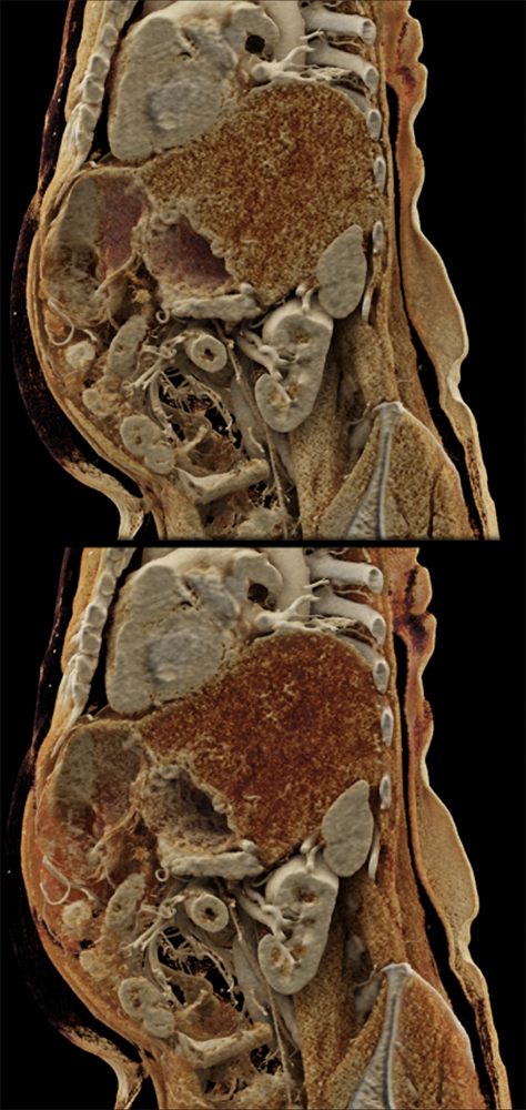 Gastric GIST Tumors