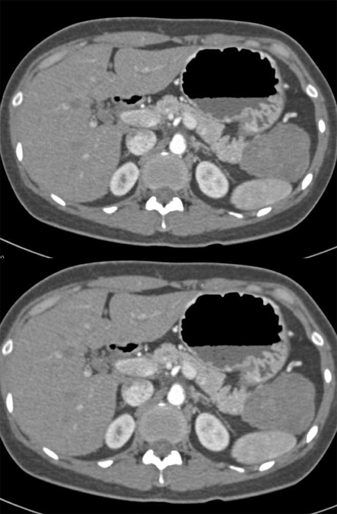 Gastric GIST Tumor Simulates a SPEN