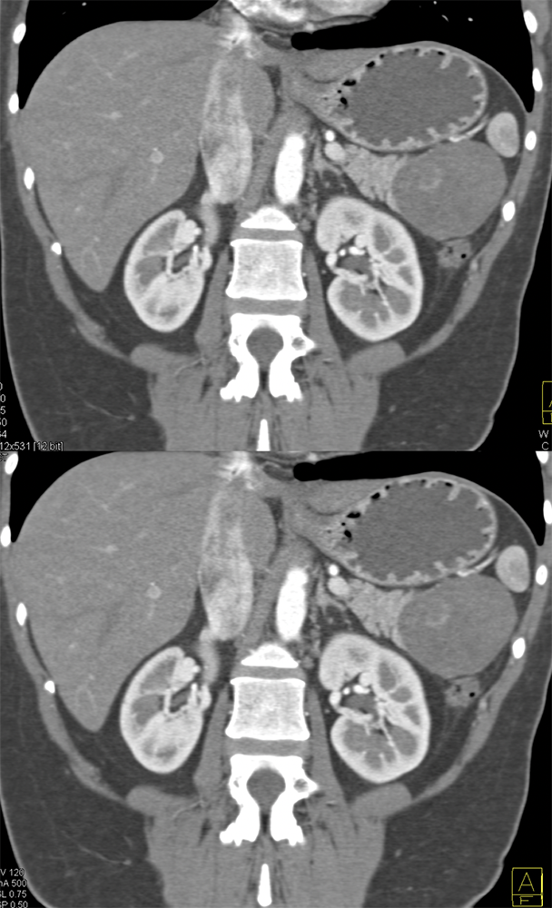 Gastric GIST Tumors