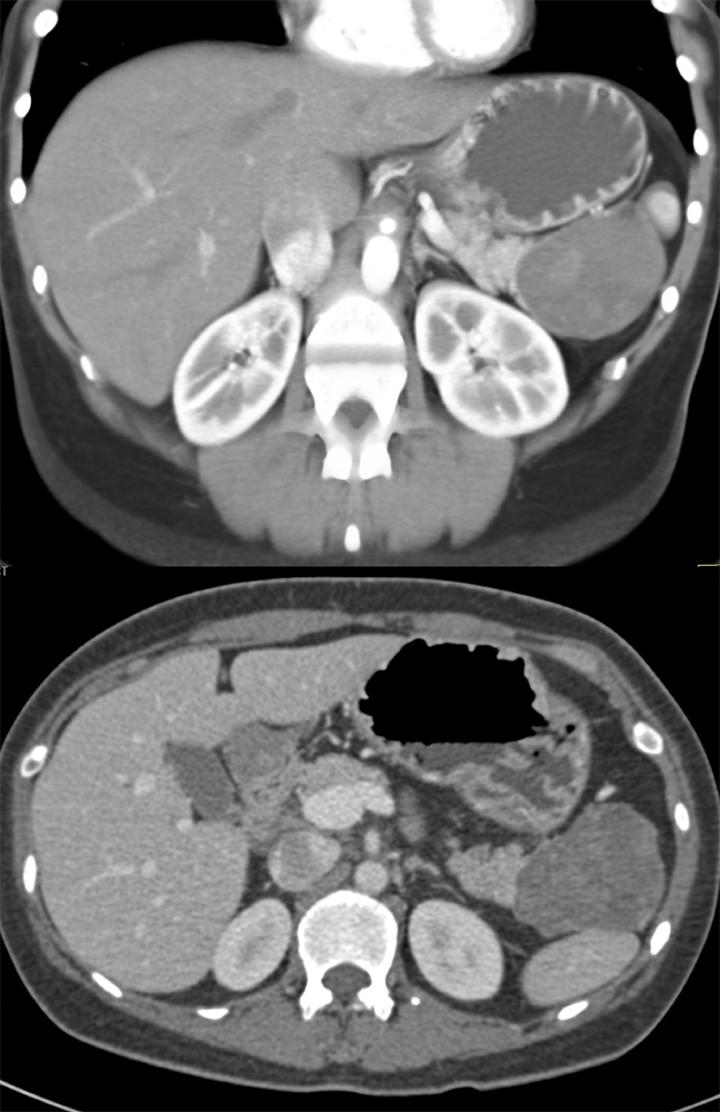 Gastric GIST Tumors