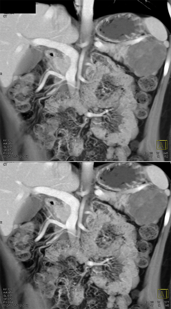 Gastric GIST Tumors