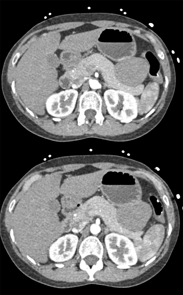 Gastric GIST Simulates Pancreatic Mass