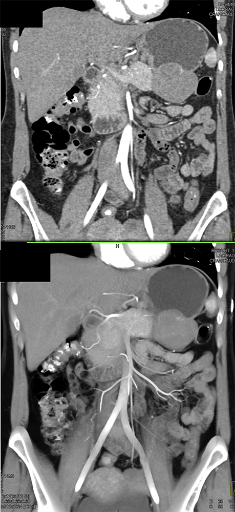 Gastric GIST Tumors