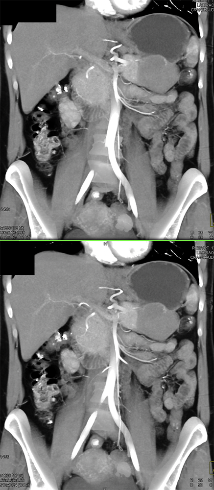 Gastric GIST Tumors