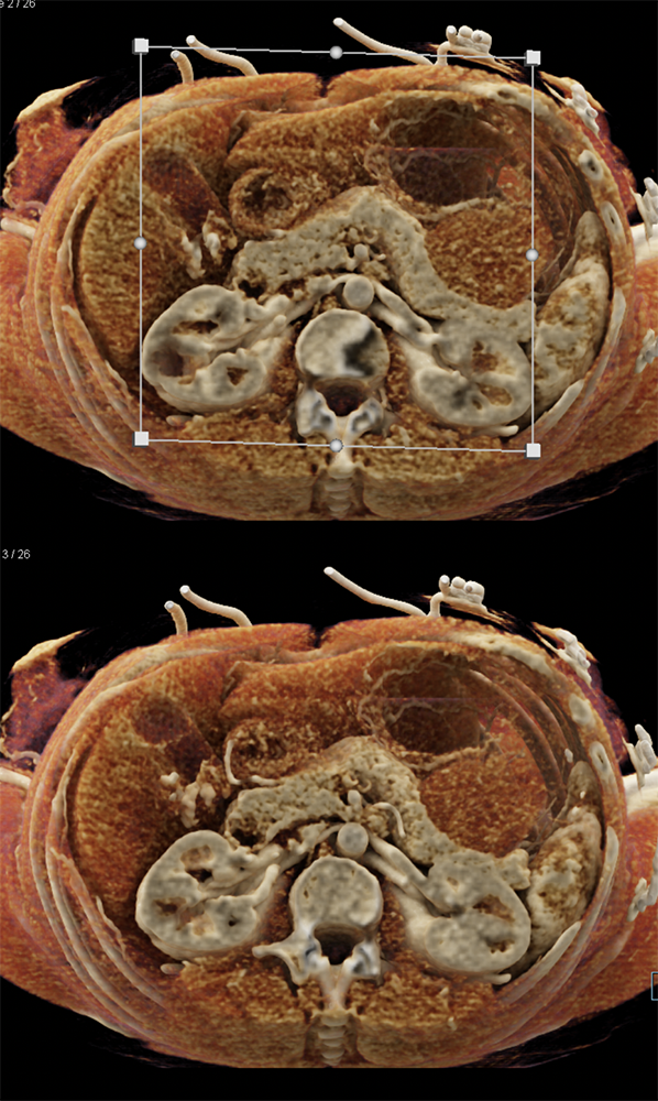 Gastric GIST Tumors