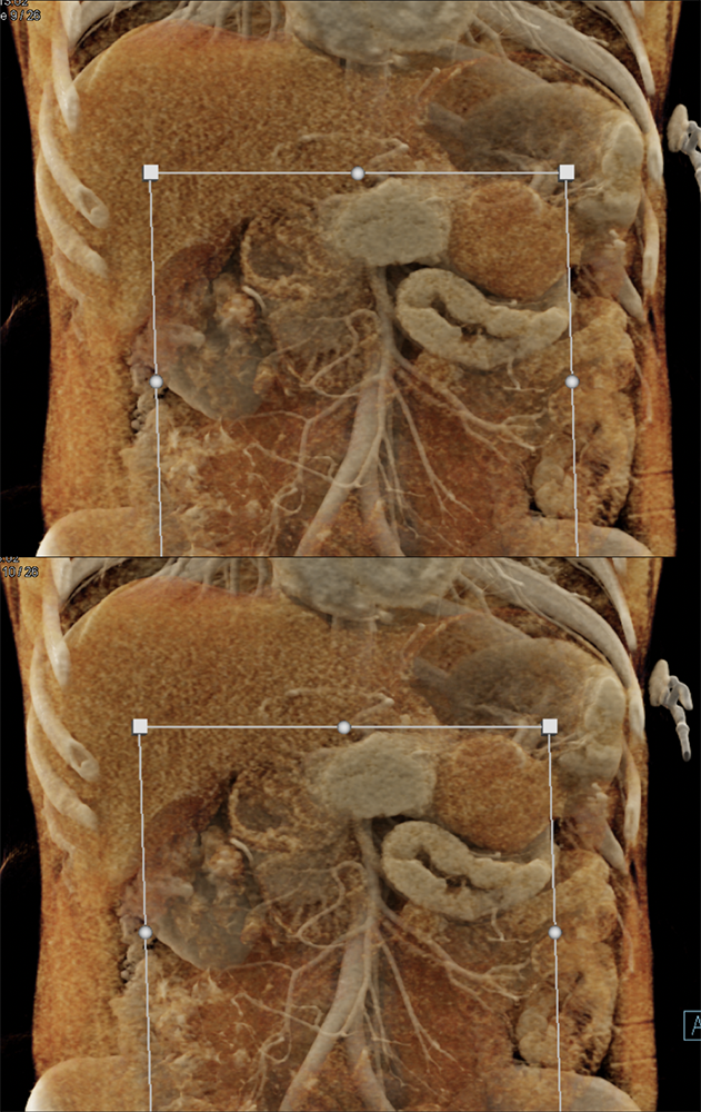 Gastric GIST Tumors