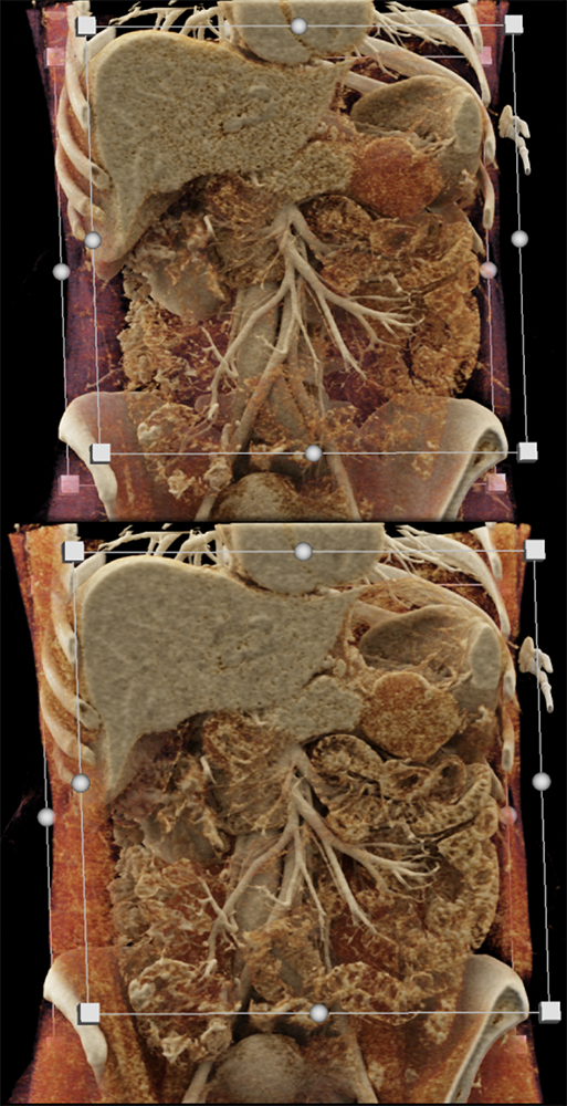 Gastric GIST Tumors