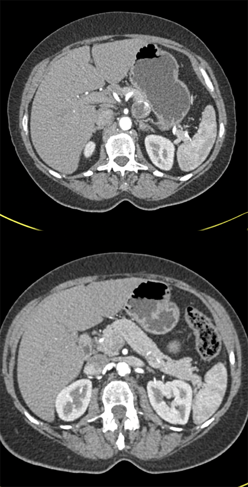 Gastric GIST Looks Like a  PNET