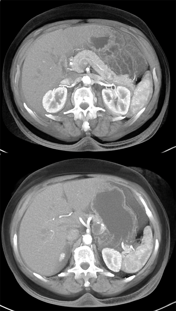 Gastric GIST Tumors